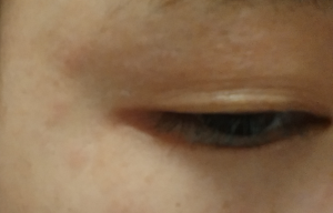 With eye cream allergy how to do what symptom has